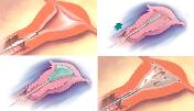 Uterine Balloon Therapy at MIOT Hospitals in Chennai, Tamil Nadu, India, affiliated to International University School of Medicine (IUSOM), which has also a Branch Campus, namely, IUSOM - MIchigan Clinical Campus in Dearborn, Michigan, USA